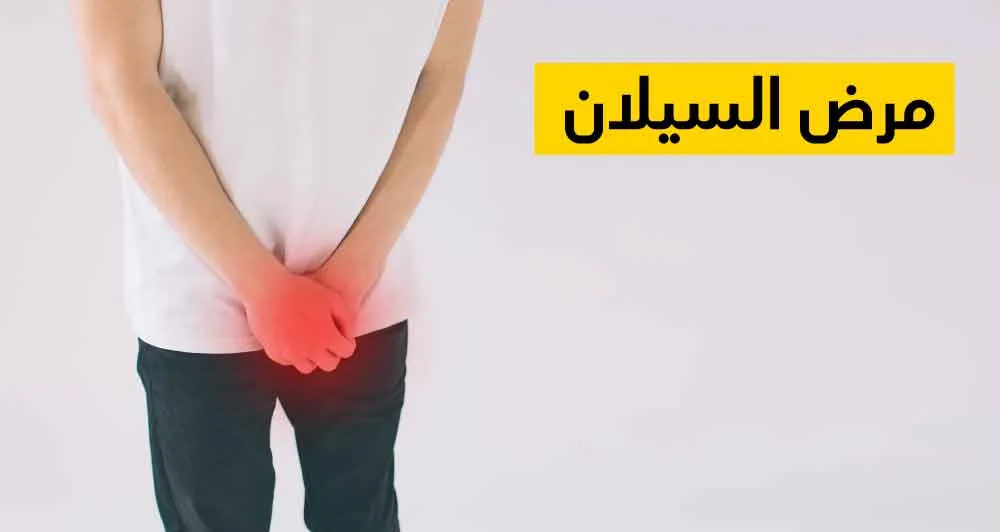 مرض السيلان